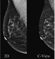 Lower Dose Tomo (C-View Software Option)