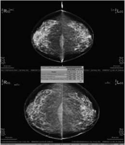 QUANTRA Breast Density Assessment Software