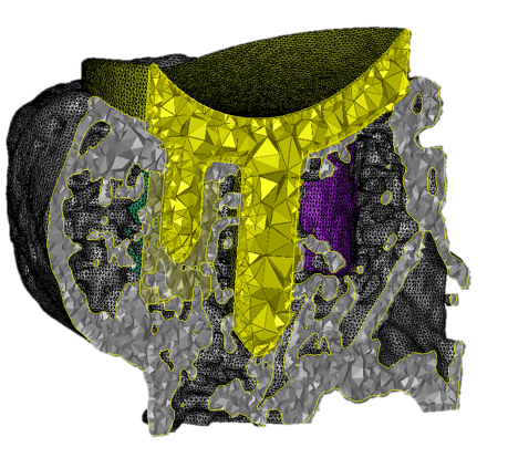 Materialise Mimics Innovation Suite